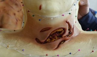 Neck-wound-prosthetics-445515